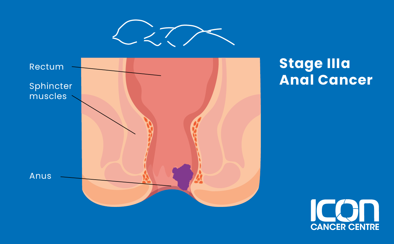 Stage IIIA anal cancer illustration