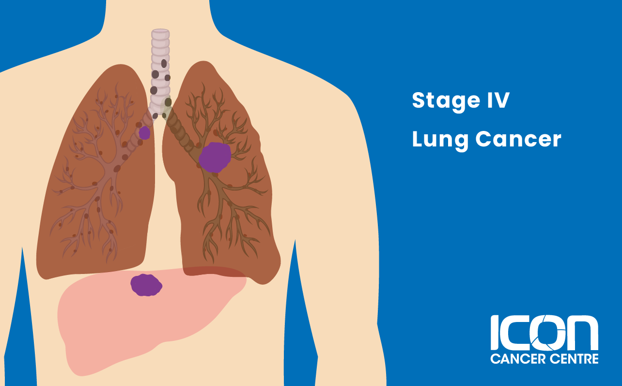 Stage IV lung cancer illustration