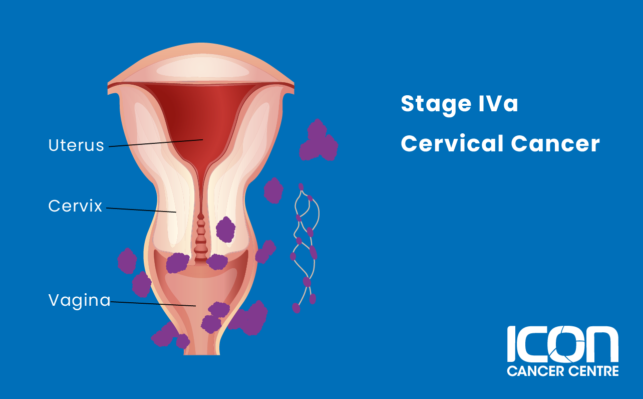 Stage IVa cervical cancer illustration