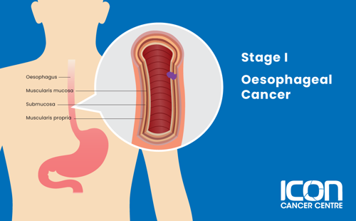Stage I oesophageal cancer illustration