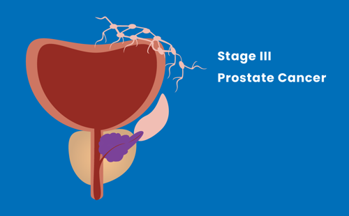 Stage III prostate cancer illustration