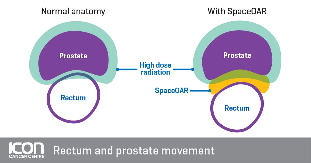 ICC Rectum and Prostate Movement SpaceOAR