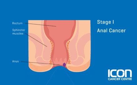 Stage 1 Anal Cancer