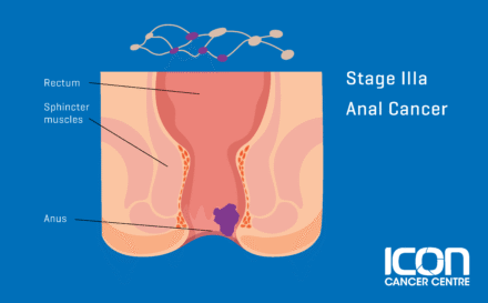 Stage 3a Anal Cancer