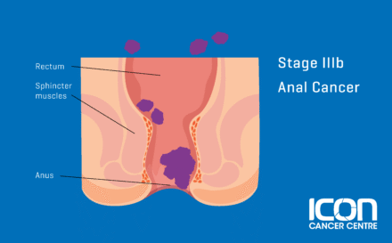 Stage 3b Anal Cancer