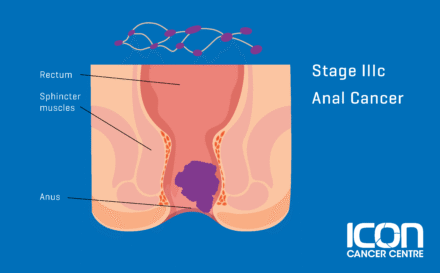 Stage 3c Anal Cancer