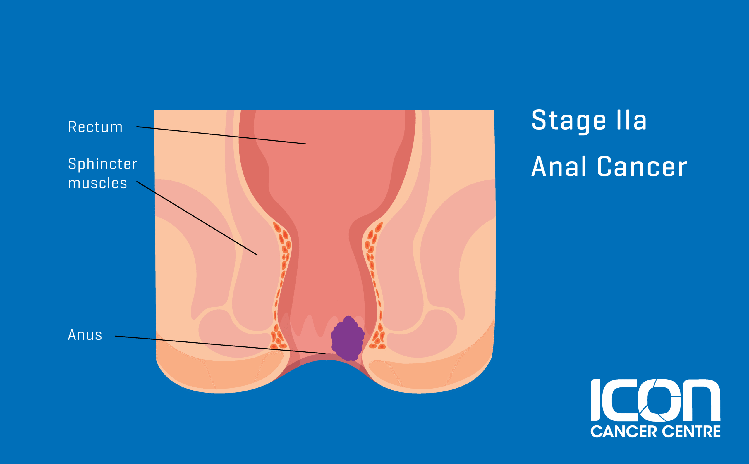 Stage 2a Anal Cancer