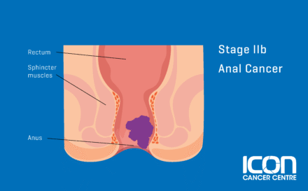 Stage 2b Anal Cancer