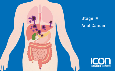 Stage 4 Anal Cancer
