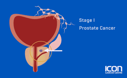Stage 1 Prostate Cancer