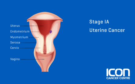 Stage 1a Uterine Cancer