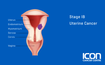 Stage 1b uterine cancer