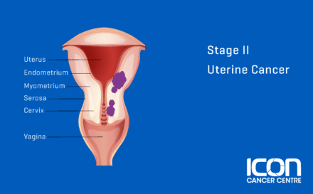 Stage 2 uterine cancer