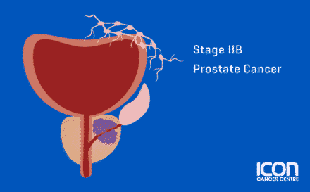Stage 2b Prostate Cancer