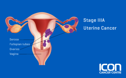 Stage 3a uterine cancer