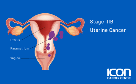 Stage 3b uterine cancer