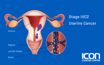 Stage 3c2 uterine cancer