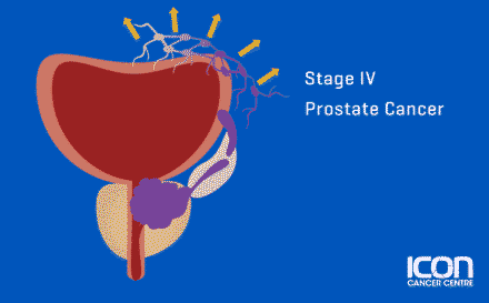 Stage 4 Prostate Cancer