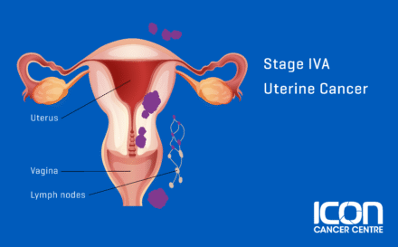 Stage 4a uterine cancer