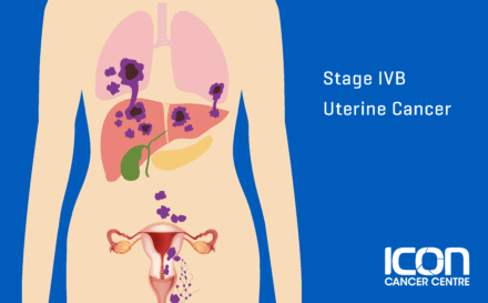 Stage 4b Uterine Cancer
