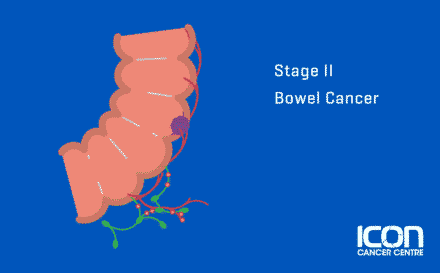 Stage 2 Bowel Cancer