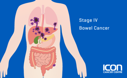 Stage 4 Bowel Cancer