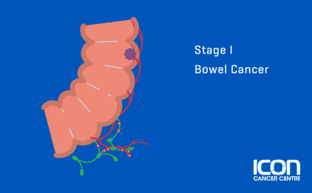 Stage 1 Bowel Cancer