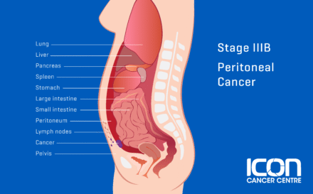 Stage 3b Peritoneal Cancer