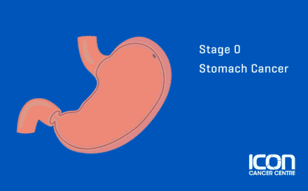 Stage Zero Stomach Cancer