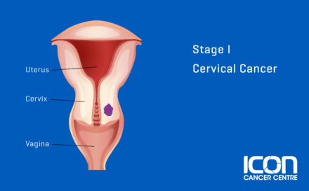 Stage 1 Cervical Cancer