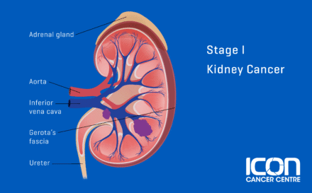 Stage 1 kidney cancer