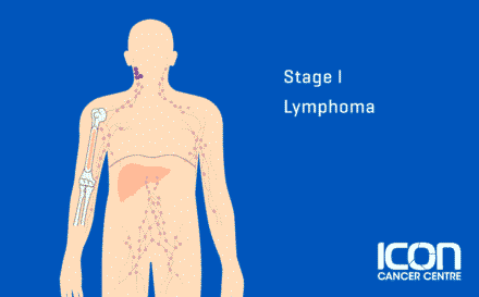 Stage 1 Lymphoma