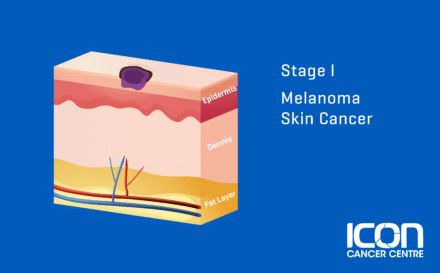 Stage 1 Melanoma