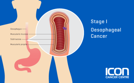 Stage 1 Oesophageal Cancer