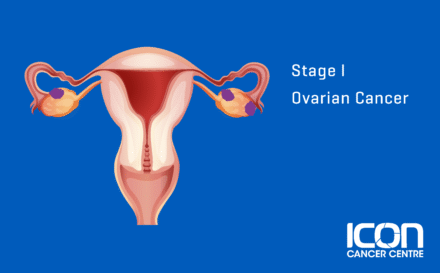 Stage 1 Ovarian Cancer
