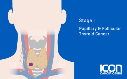 Stage 1 papillary and follicular thyroid cancer