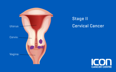 Stage 2 Cervical Cancer