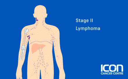 Stage 2 Lymphoma