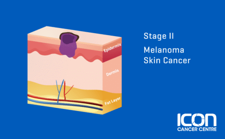 Stage 2 Melanoma