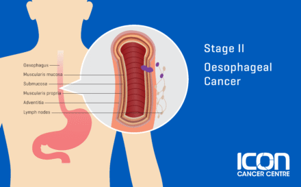 Stage 2 Oesophageal Cancer