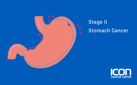 Stage 2 Stomach Cancer