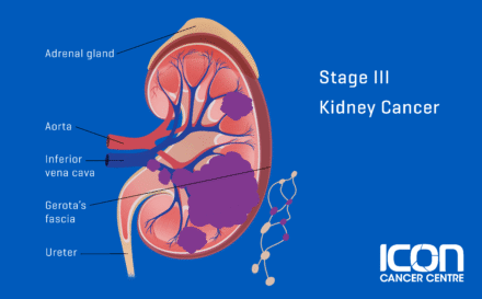 Stage 3 kidney cancer