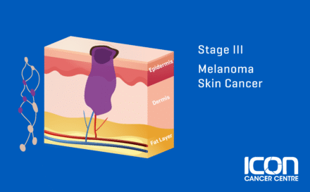 Stage 3 Melanoma