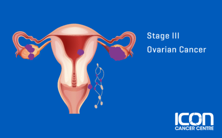Stage 3 Ovarian Cancer