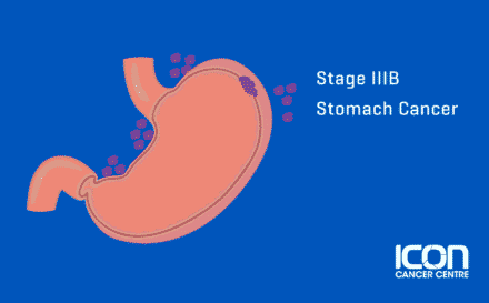 Stage 3b Stomach Cancer