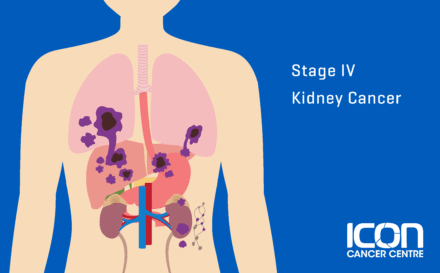 Stage 4 kidney cancer