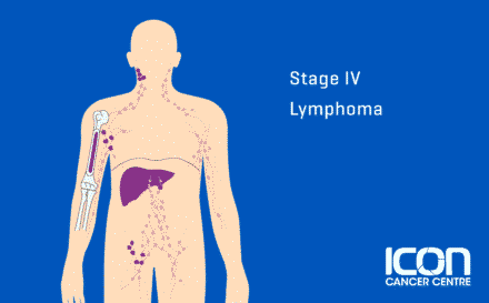 Stage 4 Lymphoma