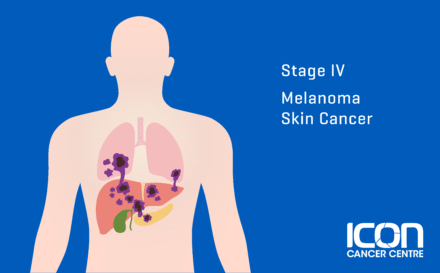 Stage 4 Melanoma