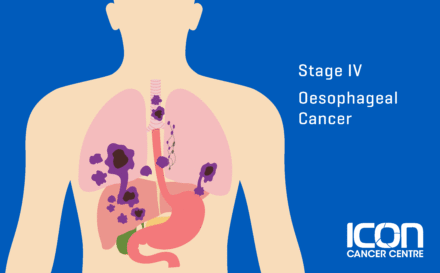 Stage 4 Oesophageal Cancer