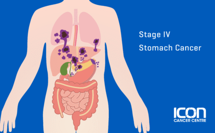 Stage 4 Stomach Cancer